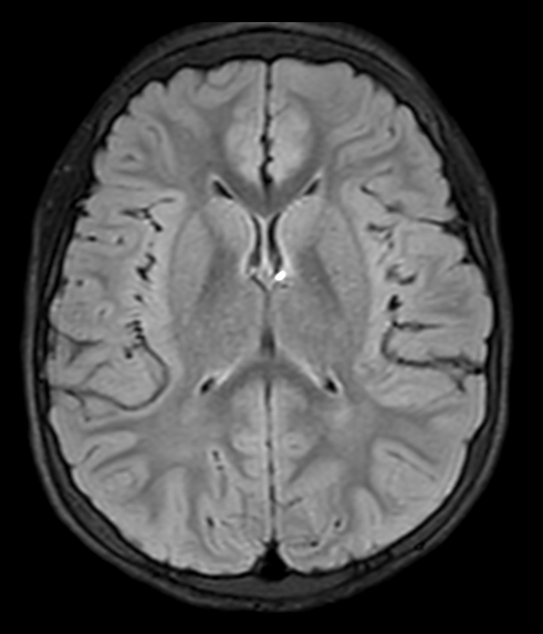 T2-weighted FLAIR (Axial)