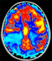 Arterial Spin Labeling