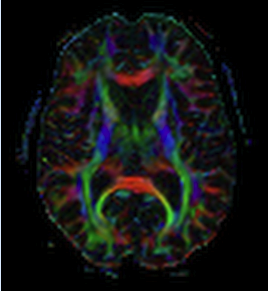 Diffusion Tensor