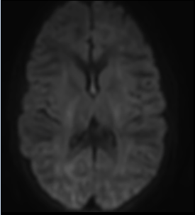 Diffusion Weighted 