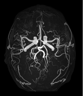 Head Angiography 