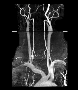 Neck Angiography