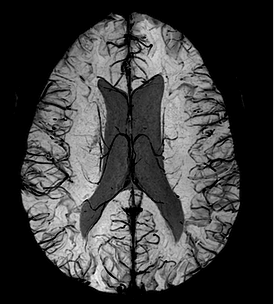 Susceptibility Weighted