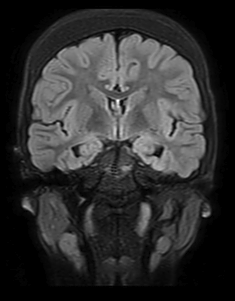Coronal t2 flair