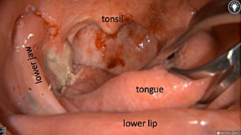 primary tumor