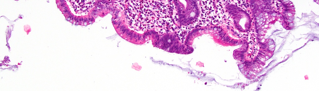 Appendix Cancer Pathology Slide