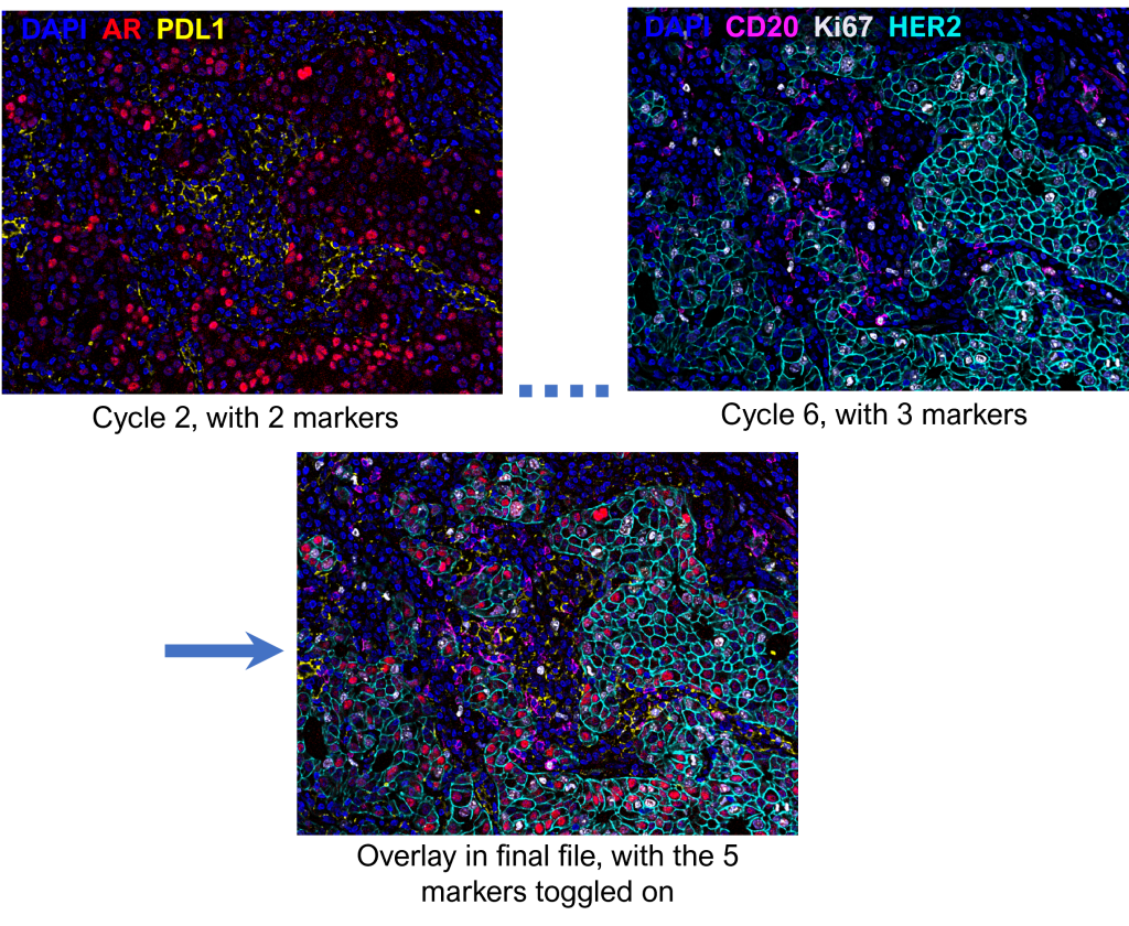 Overlay of 5 Markers in Breast Tissue