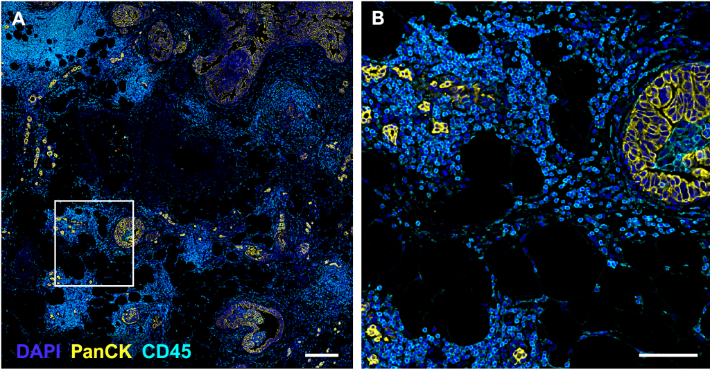 DCIS tissue for use in analysis