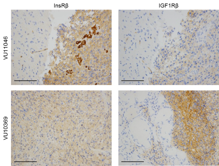 glioblastoma2