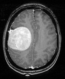 brain tumor