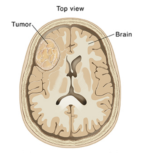 Tumor