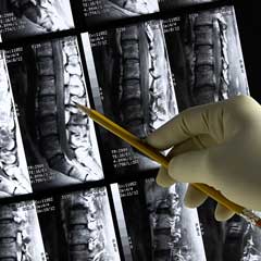 Expanding Access to Endoscopic Spine Surgery