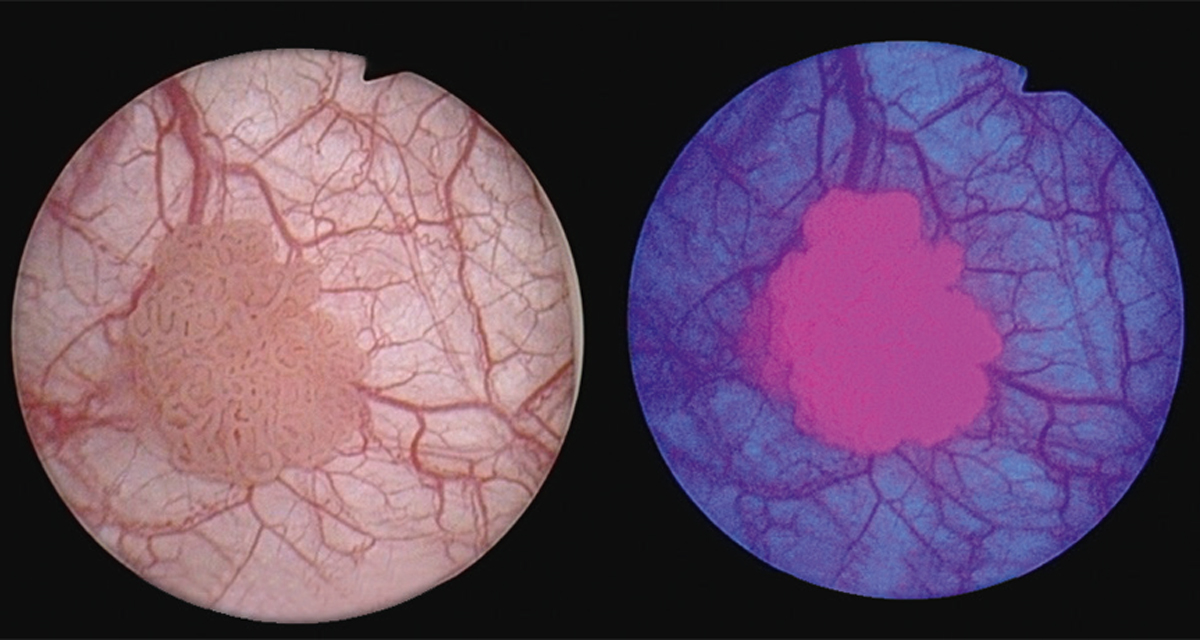 Blue Light Bladder Cancer Detection