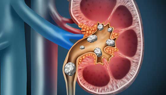 The latest kidney stone treatments
