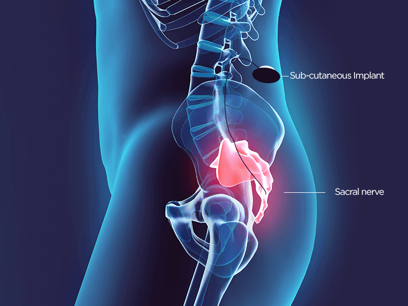 Sacral Neuromodulation Alliance for Pediatric Patients (SNAPP)