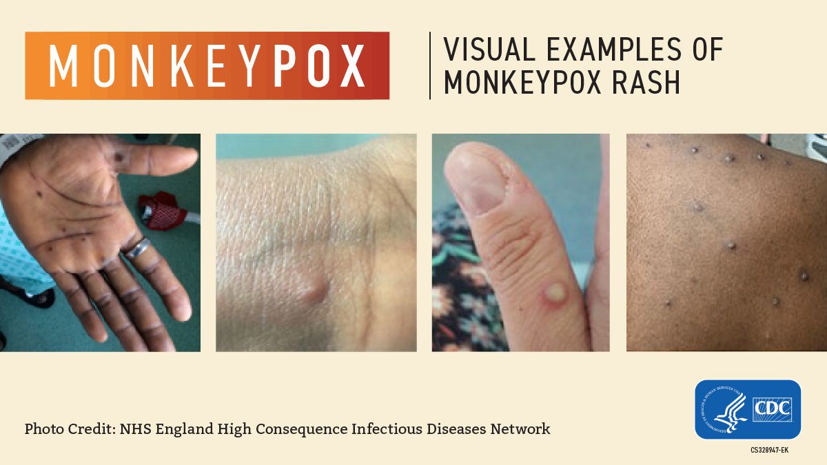 Monkeypox – symptoms, transmission, and prevention by Casey Butrico
